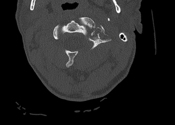 CSpine Fracture CT Axial Unannotated. JETem 2025