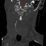 CSpine Fracture CT Coronal Annotated. JETem 2025