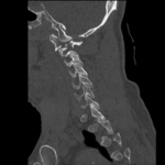 CSpine Fracture CT Sagital Unannotated. JETem 2025