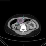 Hydropic Gallbladder. CT Axial Annotated. JETem 2025