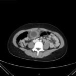 Hydropic Gallbladder. CT Axial Unannotated. JETem 2025