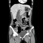 Hydropic Gallbladder. CT Coronal Unannotatd. JETem 2025
