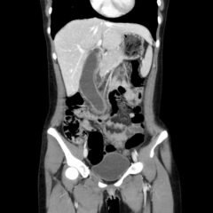 Hydropic Gallbladder. CT Coronal Unannotatd. JETem 2025