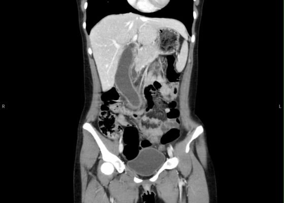 Hydropic Gallbladder. CT Coronal Unannotatd. JETem 2025