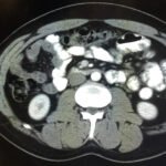 Iatrogenic Bowel Perforation Following Dental Procedure. CT. Unannotated. JETem 2025