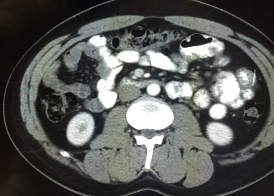 Iatrogenic Bowel Perforation Following Dental Procedure. CT. Unannotated. JETem 2025