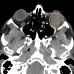 A Case Report of Inferior Rectus Abscess 4 Inferior Rectus Abscess CT Axial Annotated. JETem 2025