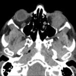 A Case Report of Inferior Rectus Abscess 1 Inferior Rectus Abscess CT Axial Unannotated. JETem 2025