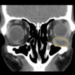 A Case Report of Inferior Rectus Abscess 5 Inferior Rectus Abscess CT Coronal Annotated. JETem 2025