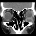 A Case Report of Inferior Rectus Abscess 2 Inferior Rectus Abscess CT Coronal Unannotated. JETem 2025