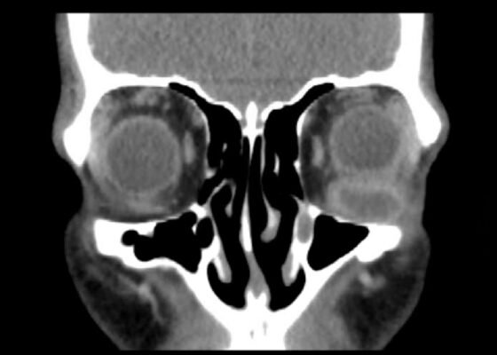 Inferior Rectus Abscess CT Coronal Unannotated. JETem 2025