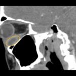 A Case Report of Inferior Rectus Abscess 6 Inferior Rectus Abscess CT Sagital Annotated. JETem 2025
