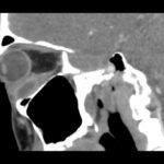 A Case Report of Inferior Rectus Abscess 3 Inferior Rectus Abscess CT Sagital Unannotated. JETem 2025