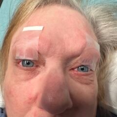 Myasthenia Gravis Eyes Taped Open. JETem 2025