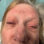 Myasthenia Gravis Eyes. JETem 2025