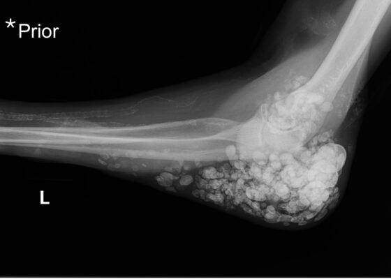 Calcinosis Cutis. Prior Elbow XR Lateral. JETem 2025