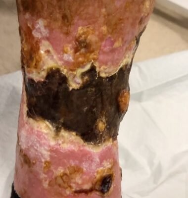 Calciphylaxis Photo LLE. JETem 2025 1