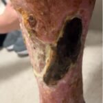 Calciphylaxis Photo RLE. JETem 2025
