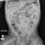 Case Report of Incarcerated Gastric Volvulus and Splenic Herniation in Undiagnosed Congenital Diaphragmatic Hernia in an Infant 1 Incarcerated Gastric Volvulus and Splenic Herniation. Abdominal Radiograph Postoperative Day 33. JETem 2025