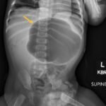 Case Report of Incarcerated Gastric Volvulus and Splenic Herniation in Undiagnosed Congenital Diaphragmatic Hernia in an Infant 4 Incarcerated Gastric Volvulus and Splenic Herniation. Abdominal Radiograph. Annotated. JETem 2025