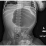 Case Report of Incarcerated Gastric Volvulus and Splenic Herniation in Undiagnosed Congenital Diaphragmatic Hernia in an Infant 2 Incarcerated Gastric Volvulus and Splenic Herniation. Abdominal Radiograph. Unannotated. JETem 2025