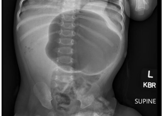 Incarcerated Gastric Volvulus and Splenic Herniation. Abdominal Radiograph. Unannotated. JETem 2025