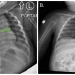 Case Report of Incarcerated Gastric Volvulus and Splenic Herniation in Undiagnosed Congenital Diaphragmatic Hernia in an Infant 5 Incarcerated Gastric Volvulus and Splenic Herniation. Chest Radiographs on Postoperative Days 1 and 4. Annotated. JETem 2025