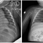 Case Report of Incarcerated Gastric Volvulus and Splenic Herniation in Undiagnosed Congenital Diaphragmatic Hernia in an Infant 3 Incarcerated Gastric Volvulus and Splenic Herniation. Chest Radiographs on Postoperative Days 1 and 4. Unannotated. JETem 2025