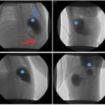 Case Report of Incarcerated Gastric Volvulus and Splenic Herniation in Undiagnosed Congenital Diaphragmatic Hernia in an Infant 7 Incarcerated Gastric Volvulus and Splenic Herniation. Upper GI. Annotated. JETem 2025