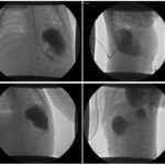 Case Report of Incarcerated Gastric Volvulus and Splenic Herniation in Undiagnosed Congenital Diaphragmatic Hernia in an Infant 6 Incarcerated Gastric Volvulus and Splenic Herniation. Upper GI. Unannotated. JETem 2025
