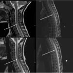 Mycoplasma Associated Acute Transverse Myelitis. MRI. Annotated. JETem 2025