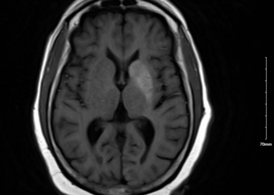 Nonketotic Hyperglycemia Hemichorea. MRI Unnnotated. JETem 2025