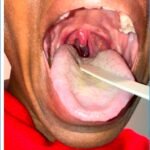 Uvular Necrosis Photo. Unannotated. JETem 2025