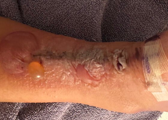 Dermatologic Reaction to Wound Closure Strips and Liquid Adhesive. Photo 3 Unannotated. JETem 2025