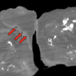 Atypical Presentation of Fourniers Gangrene. CT annotated. JETem 2026