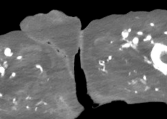 Atypical Presentation of Fourniers Gangrene. CT. JETem 2026