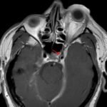 Carotid Cavernous Fistula MRI 1 annotated red arrow. JETem 2026