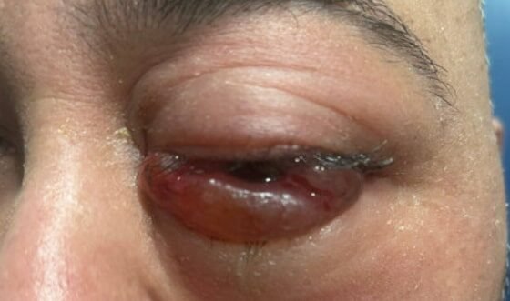 Carotid Cavernous Fistula Photograph. JETem 2026