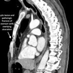 Open Chest Wound. CT annotated. JETem 2026