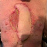 Open Chest Wound. Photo Post Surgery. JETem 2026