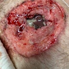 Open Chest Wound. Photo. JETem 2026