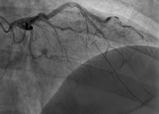 SCAD. Angiography. JETem 2026
