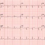SCAD. ECG. JETem 2026